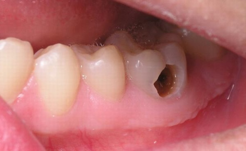 Mảng bám dẫn đến sâu răng
